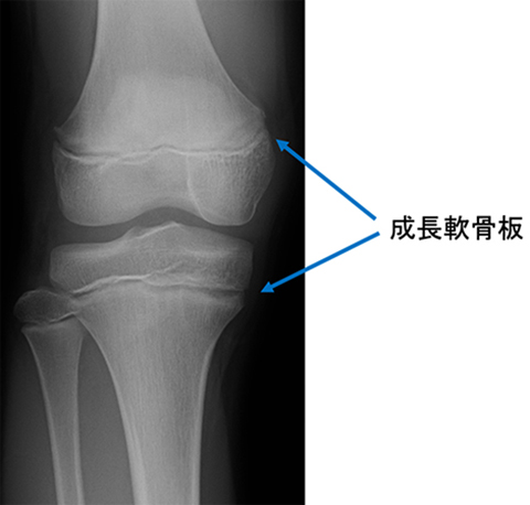 発育期の骨の成長